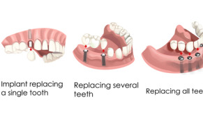DENTAL Implants
